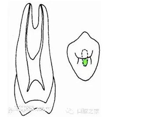 根管治疗之根管口的探查要点  