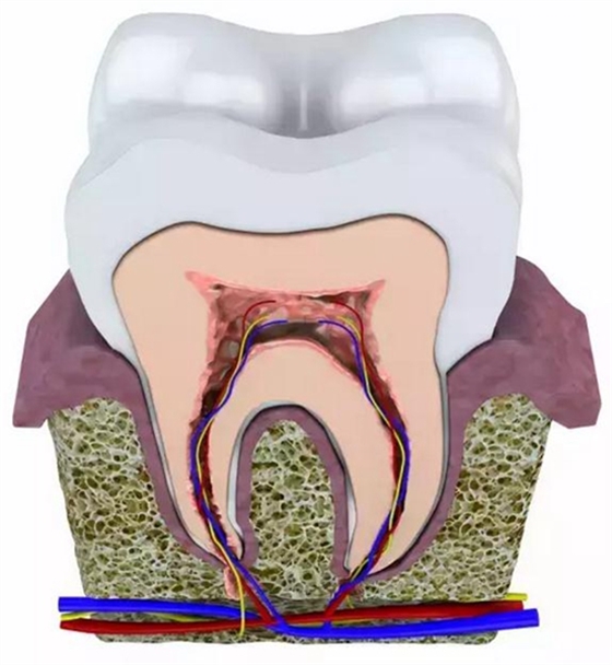 根管治疗中如何避免牙根纵裂（Vertical Root Fracture,VRF）