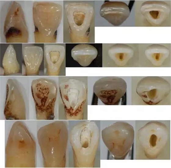 各牙齿的大概的开髓形态