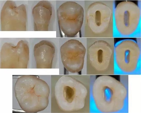 各牙齿的大概的开髓形态