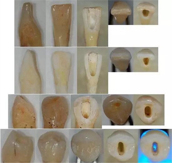 各牙齿的大概的开髓形态