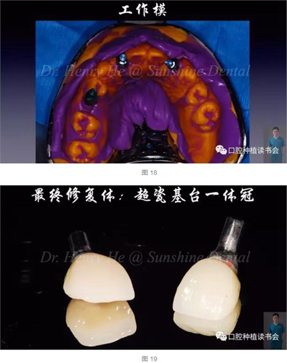 2017口腔医师口腔组织病理之牙龈病