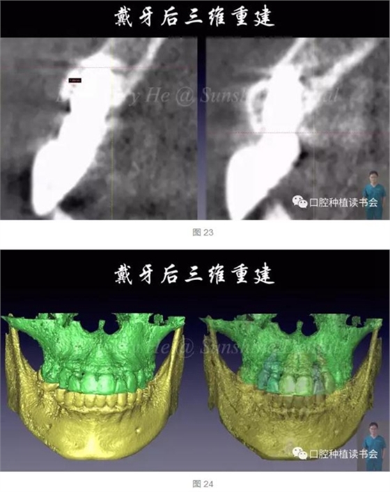 2017口腔医师口腔组织病理之牙龈病