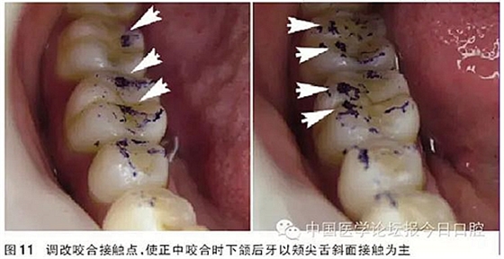 凸凹式后牙咬合接触及其临床意义——王美青教授