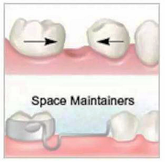乳牙缺失致恒牙“乱长”，这个“间隙保持器”可预防