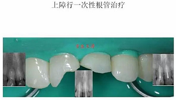 前牙外伤冠延长+全瓷冠修复