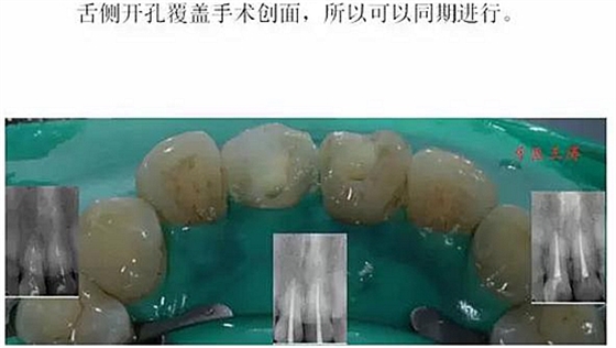 前牙外伤冠延长+全瓷冠修复