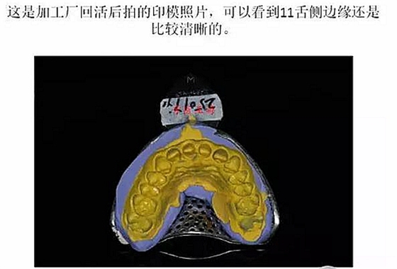 前牙外伤冠延长+全瓷冠修复