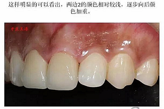 前牙外伤冠延长+全瓷冠修复