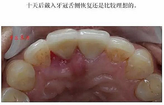 前牙外伤冠延长+全瓷冠修复