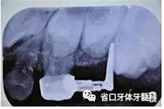 【牙医学堂】间隙保持器的介绍  