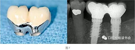 粘接固位基台的使用注意事项