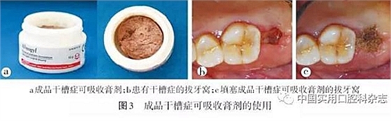 干槽症的发生原因至今不明,目前认为与手术创伤过大,局部血运较差