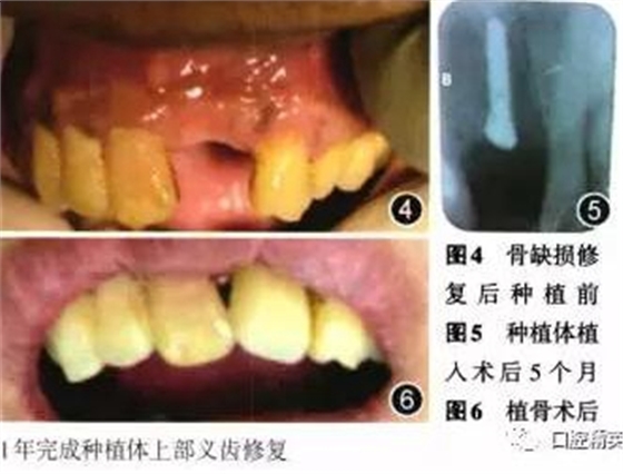 组织工程骨修复上颌骨缺损及牙种植一例 