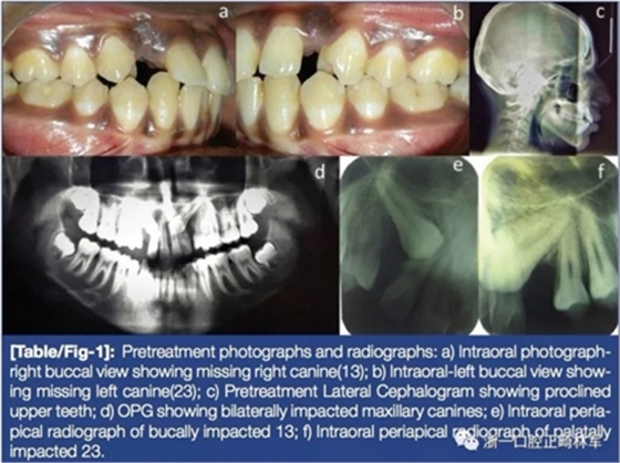 文献优秀正畸病例赏析--牙周加速成骨正畸（PAOO）辅助的腭侧埋伏尖牙牵引矫治及5年跟踪随访