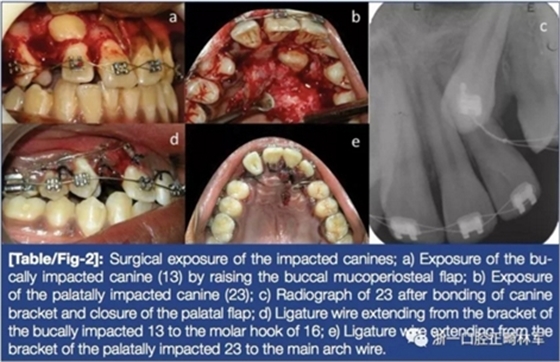 文献优秀正畸病例赏析--牙周加速成骨正畸（PAOO）辅助的腭侧埋伏尖牙牵引矫治及5年跟踪随访