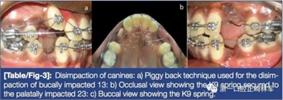 文献优秀正畸病例赏析--牙周加速成骨正畸（PAOO）辅助的腭侧埋伏尖牙牵引矫治及5年跟踪随访
