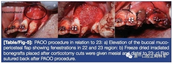 文献优秀正畸病例赏析--牙周加速成骨正畸（PAOO）辅助的腭侧埋伏尖牙牵引矫治及5年跟踪随访