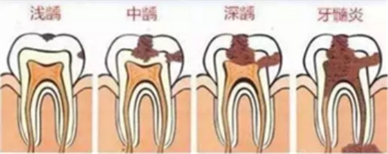 当心“腹黑”龋齿，牙齿有个小洞也要补！