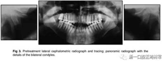 文献优秀正畸病例赏析-通过微种植钉及多曲方丝技术压低下颌磨牙非手术矫治严重前牙开合患者1例