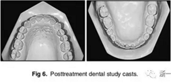 文献优秀正畸病例赏析-通过微种植钉及多曲方丝技术压低下颌磨牙非手术矫治严重前牙开合患者1例