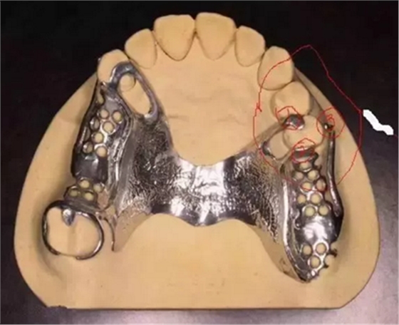 活动义齿修复，要懂的钢托设计