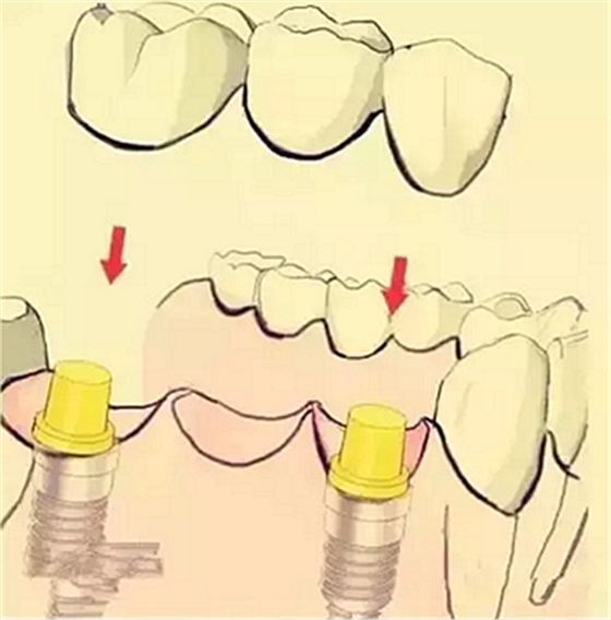 【牙齿种植】健康牙齿“种”出来