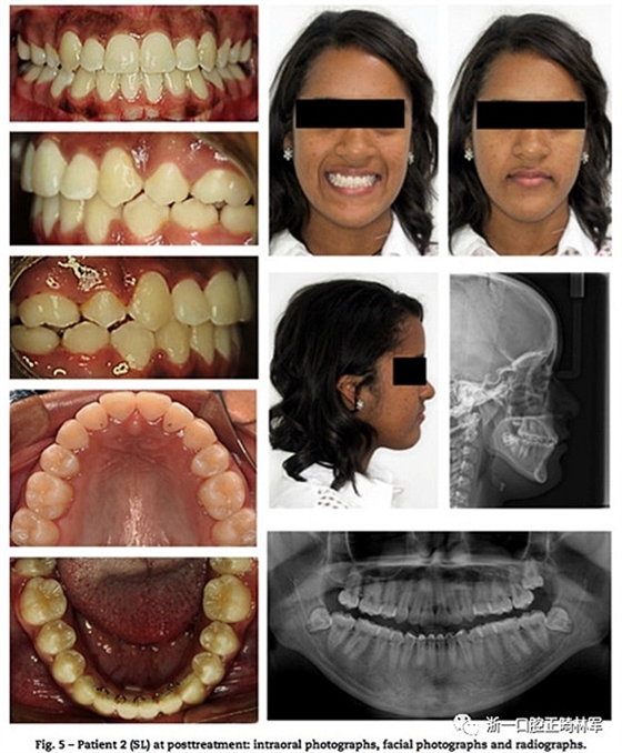 文献优秀正畸病例赏析--同卵双胞胎使用自锁托槽和传统托槽正畸治疗比较