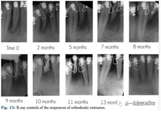 文献优秀正畸病例赏析--正畸牙周联合治疗方法病例介绍