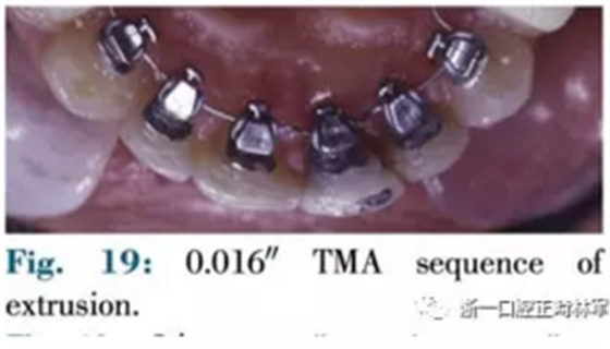 文献优秀正畸病例赏析--正畸牙周联合治疗方法病例介绍
