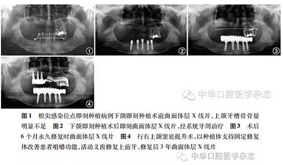 【专家笔谈】即刻种植治疗方案的评估与实施