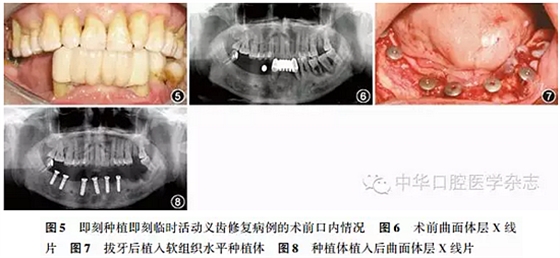 【专家笔谈】即刻种植治疗方案的评估与实施