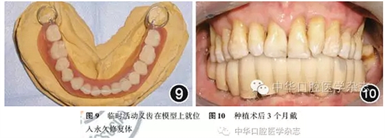 【专家笔谈】即刻种植治疗方案的评估与实施