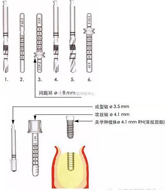 Sraumann种植系统外科操作流程