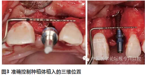 手把手教你做种植软组织成形