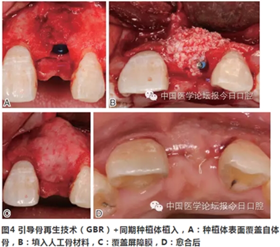 手把手教你做种植软组织成形