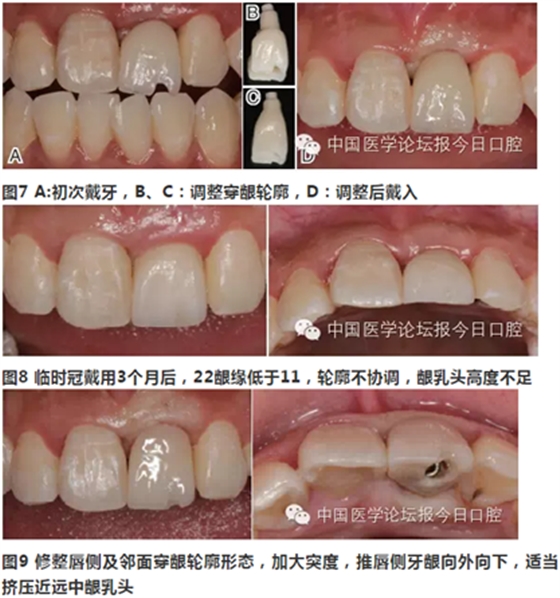 手把手教你做种植软组织成形