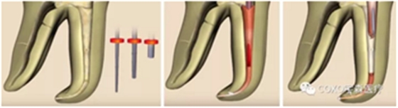 知识分享：根管治疗的标准步骤