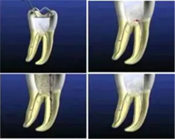 知识分享：根管治疗的标准步骤