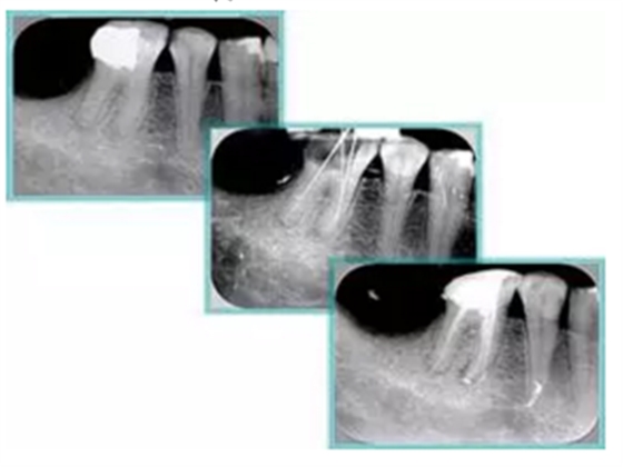 知识分享：根管治疗的标准步骤