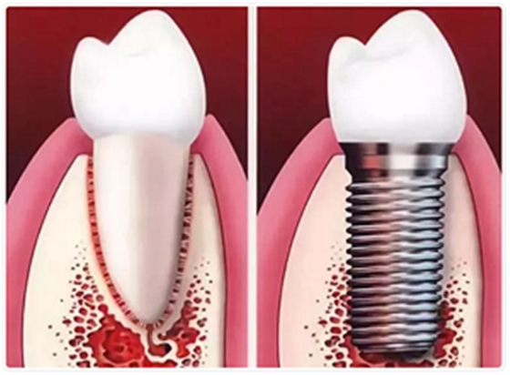 种植牙常见问答你知道多少？