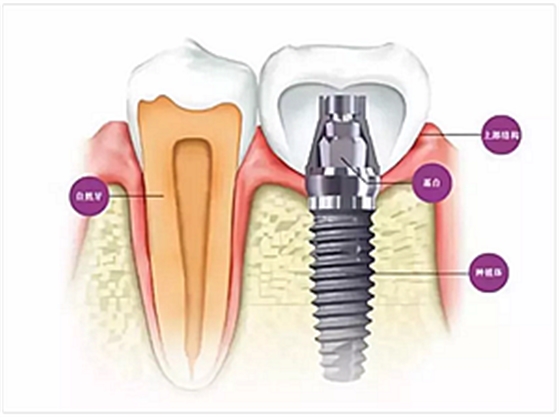 种植牙常见问答你知道多少？