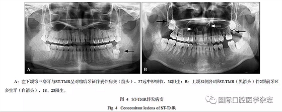 46例患者第三磨牙区多生牙的影像学分析