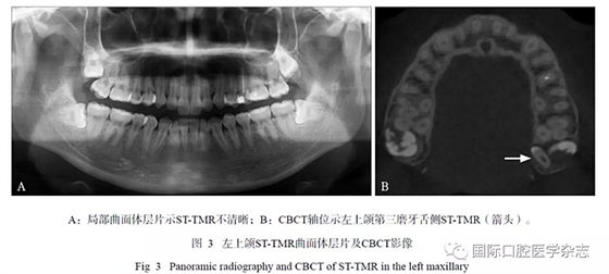 46例患者第三磨牙区多生牙的影像学分析