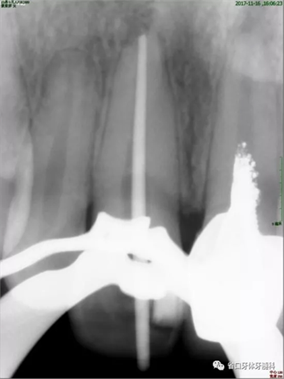 上前牙根管再治疗后内漂白1例