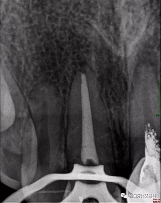 上前牙根管再治疗后内漂白1例