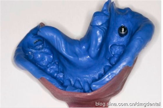 德国DMG哈尼格二代加聚硅橡胶Heavy种植印模病例展示 Part 1