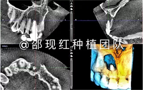 「科普篇」你真的了解它吗？——β-磷酸三钙