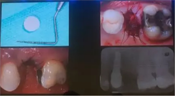 【听课笔记】拔牙后位点的软硬组织处理