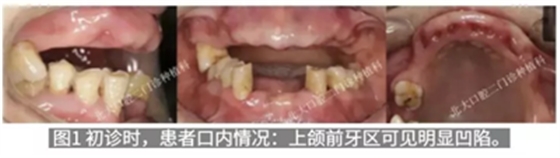 病例报道│全程数字化辅助无牙颌种植即刻负重